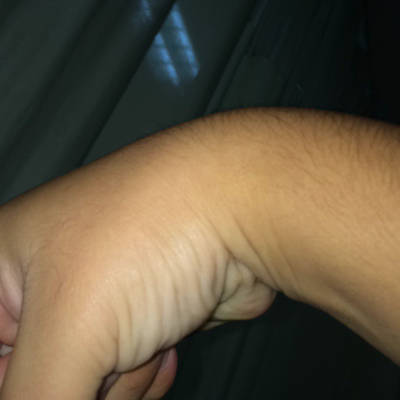 应该是腱鞘炎,我是月子里抱孩子用手拖住她的头,所以手脖子