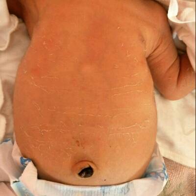 新生儿正常腹部照片图片