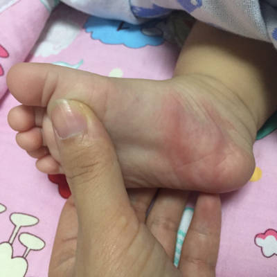 宝宝六个月 前天晚上被蚊子咬了脚丫 红肿而且有两条红肿的 有可能是
