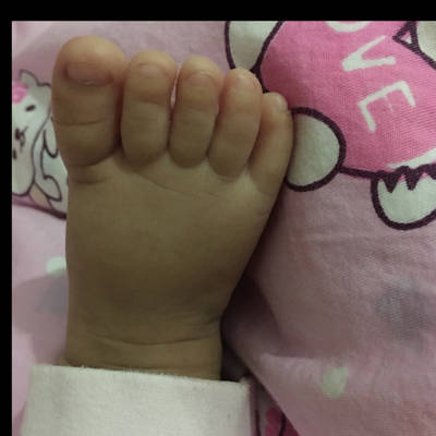 请问宝宝这样的脚趾正常吗?前边的一样齐相片的原因看的不清楚