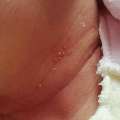 新生儿脓疱疹 婴儿图片