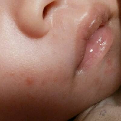 宝宝脸上起的是什麼呀,宝妈们知道吗,感觉不怎麼像奶癣