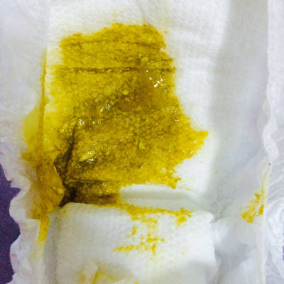 孩子拉这种粑粑正常吗?今天3次了