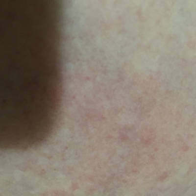 乳房湿疹初期症状图片图片