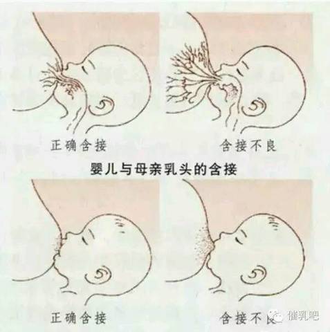 别小看积奶,处理不当就变成乳腺炎了