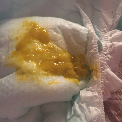 三个半月的宝宝纯母乳,拉这样的便便正常吗