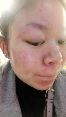 油性痘痘肌用什麼护肤品好