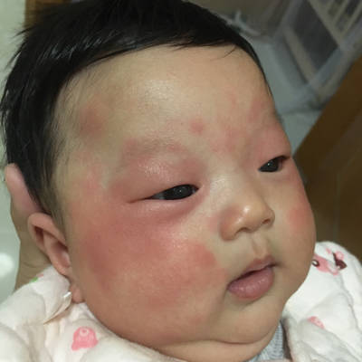 为什麼又红又痒,2个月14日的宝宝,母乳餵养的.