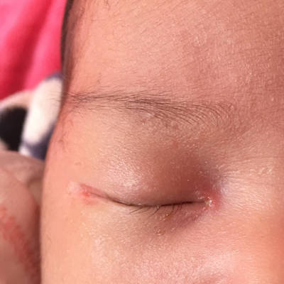 6个月宝宝角膜炎图图片