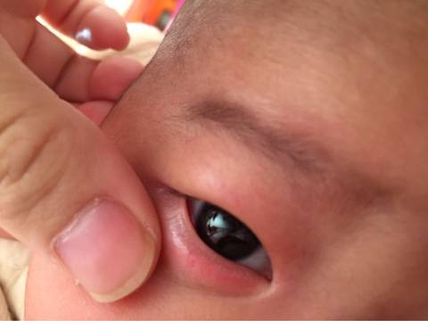 三个月宝宝下眼睑很红,有时还有小疹子,有图
