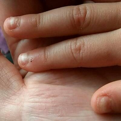 妈妈们帮帮我吧宝宝3岁指甲盖起初出现白结,后来1个多月左右出现分层