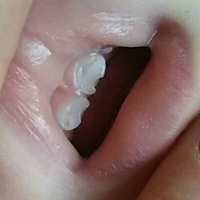 宝宝牙齿怎麼回事?