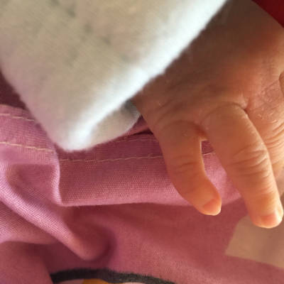 我家宝宝的小手指是歪的,怎麼办啊!两只都歪,以后能变直吗?