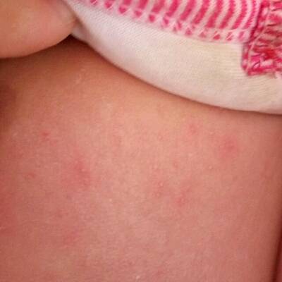 婴儿环状湿疹图片