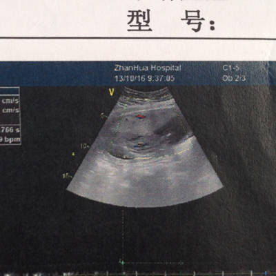 孕16周胎儿彩超图图片