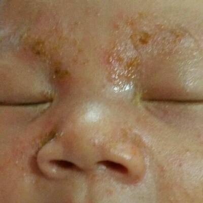 宝宝脸上长火毒的图片图片