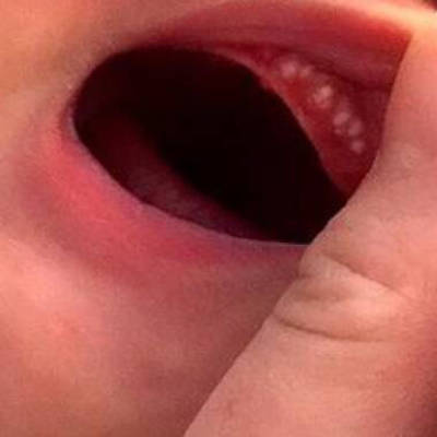 新生儿长马牙子图片图片
