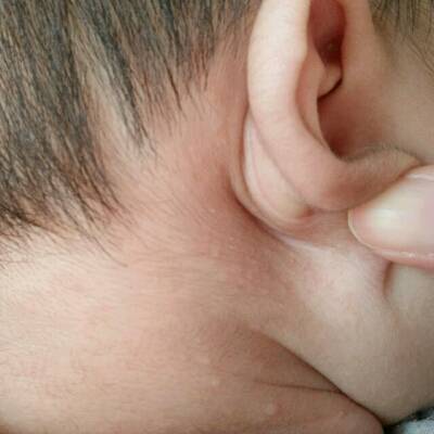 宝宝耳朵后的小包图片