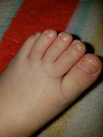 宝宝2岁脚趾头起皮,脚趾甲发黄,什麼原因