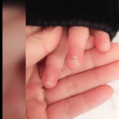 我宝宝一岁半每次长出来的指甲长到一半就往上翘是怎麼回事啊?