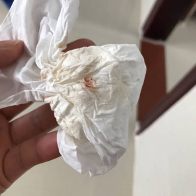 今天儿子吐出的奶有血,吃东西正常,拉屎也正常,一切正常,就是吐出的奶