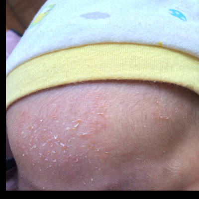 婴儿湿疹额头图片