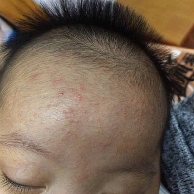 婴儿头发里长湿疹图片图片