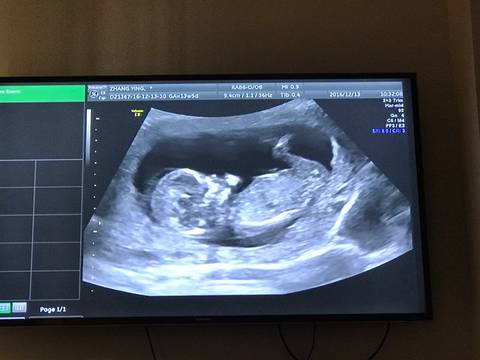 怀孕12周胎儿彩超图片图片