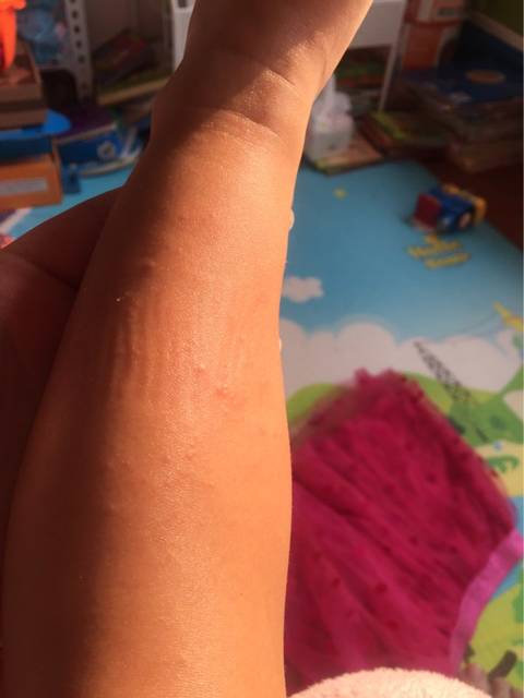 湿疹好了很多鸡皮疙瘩(干性湿疹像鸡皮疙瘩似的图片)