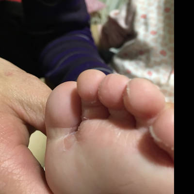 15个月宝宝脚趾头那块褪皮是怎麼了?