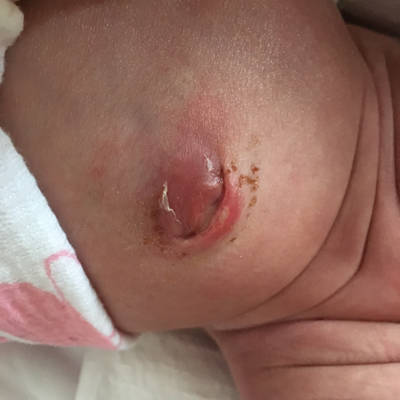 宝宝肚脐已经22天了还是这个样子,消毒碘伏也都在消得可还是不见好,这