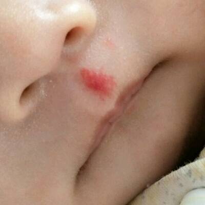 宝宝嘴唇血管瘤图片图片
