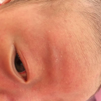 新生儿眼角有红点图片图片