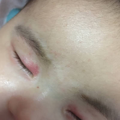 我家宝宝出生眼角就有一个红色印记,不知道这是胎记还是什么?