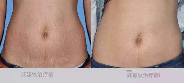 妊娠纹治疗
