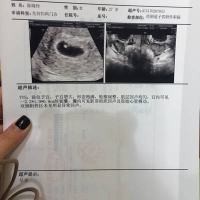 怀孕50天孕囊多大图片图片