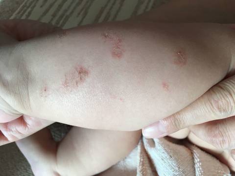 婴儿湿疹刚开始的图片图片