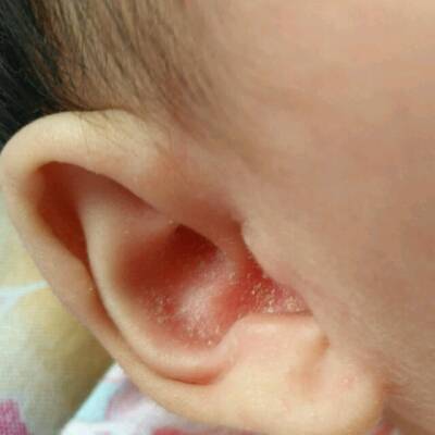 我家宝宝耳朵里好像生耳朵底儿了,都是小结痂,用双氧水可以吗
