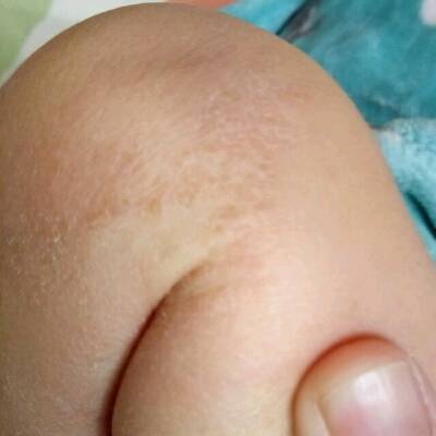 宝宝大腿纹路图片
