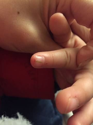 宝宝指甲里扎了刺怎麼办?