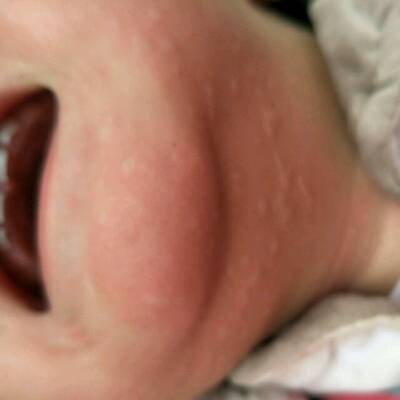 宝宝转奶过敏红疹图片图片