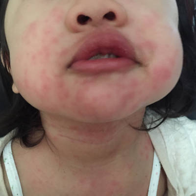 宝宝脸上过敏起红疹,可以洗脸吗?