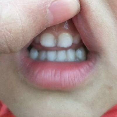宝妈们,我家宝的两颗门牙间有黑色能不能吃