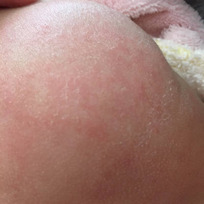 婴儿母乳性湿疹图片图片