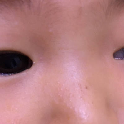 婴儿口鼻周围发青图片图片