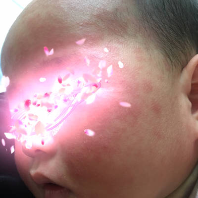 宝宝发烧病毒疹图片图片