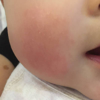 我家宝宝四个月 脸蛋上起的红疙瘩 摸着像是有嘎巴似的 就两个脸蛋上