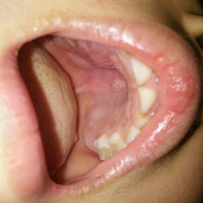 孩子牙疼的很厉害,就带孩子去了医院检查,检查结果是牙龈肿了,而且裏