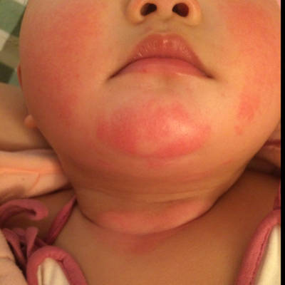 儿童嘴巴下巴起红疹子图片