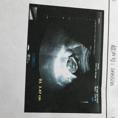 早期怀孕彩超图片图片